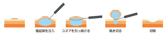 内視鏡的粘膜切除術（EMR）の流れ