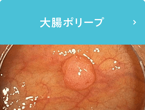 大腸ポリープ