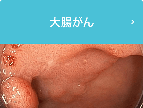 大腸がん