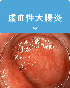 虚血性大腸炎