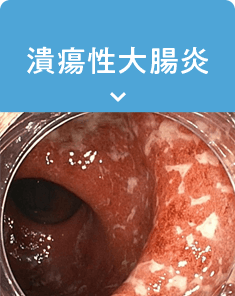 潰瘍性大腸炎