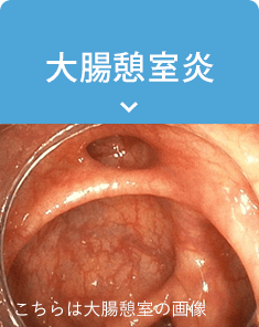 大腸憩室炎